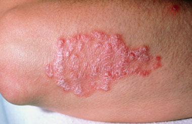 Los medios públicos la psoriasis la ingle